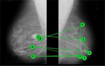 Image: In the study, gaze direction was used to nudge novices into following an expert radiologist’s scanpath (a simplified version of which is shown in green) as they looked at a mammogram. A potential tumor is circled (Photo courtesy of Washington University in St. Louis).